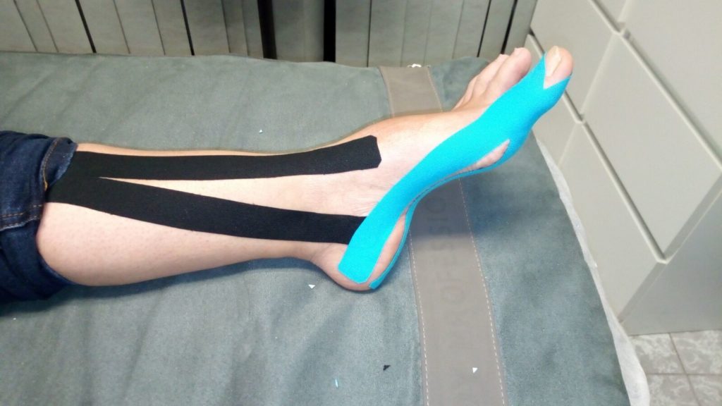 Clinica del pie Canillejas San Blas,Vendajes Neuromusculares